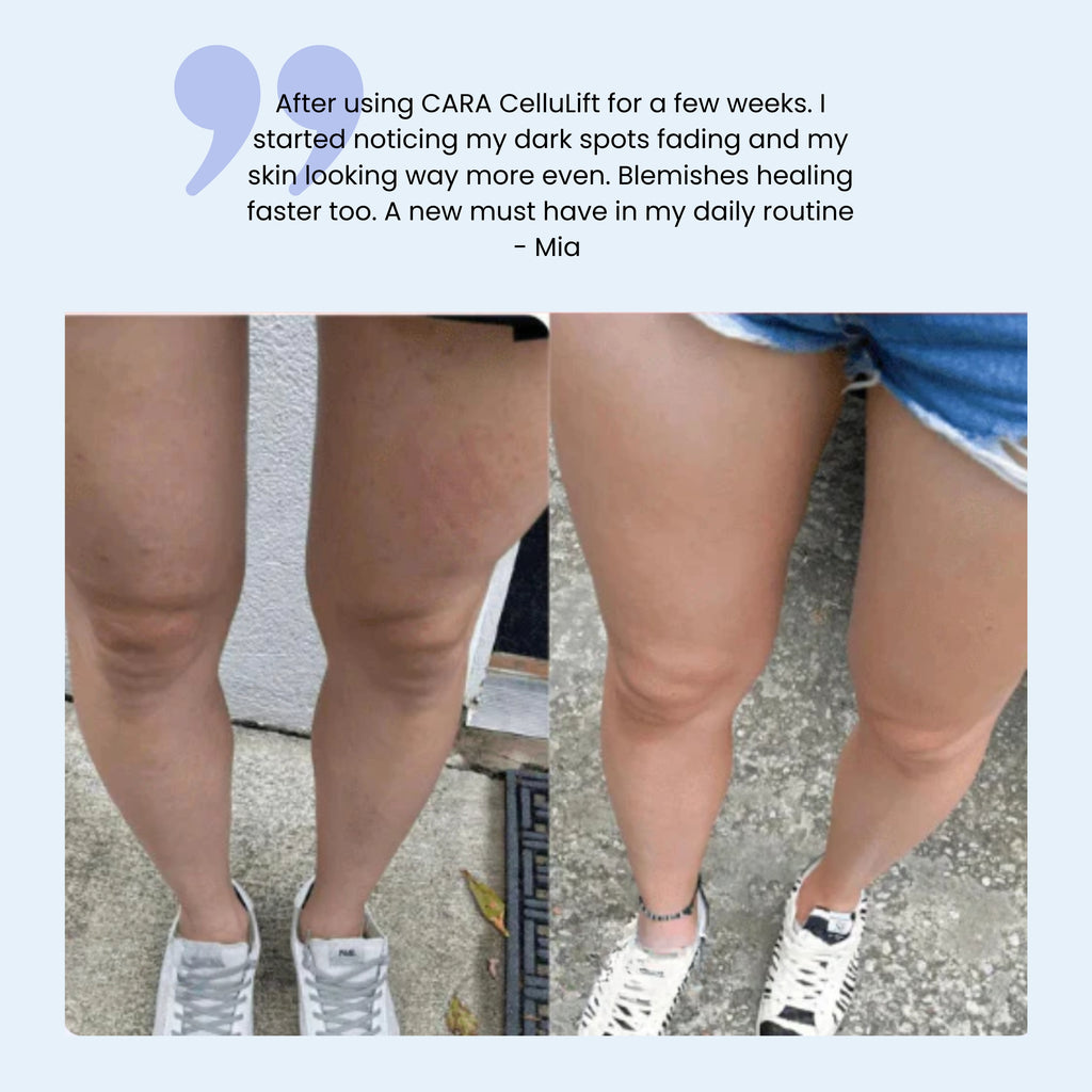 CARA CelluLift™ – Your At-Home Body Renewal Kit
