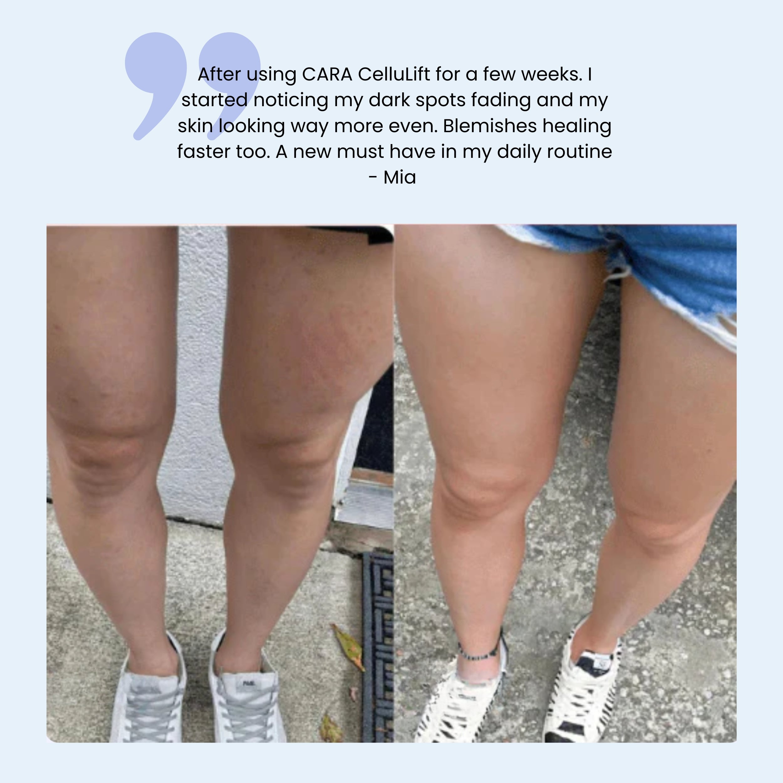 CARA CelluLift™ – Your At-Home Body Renewal Kit